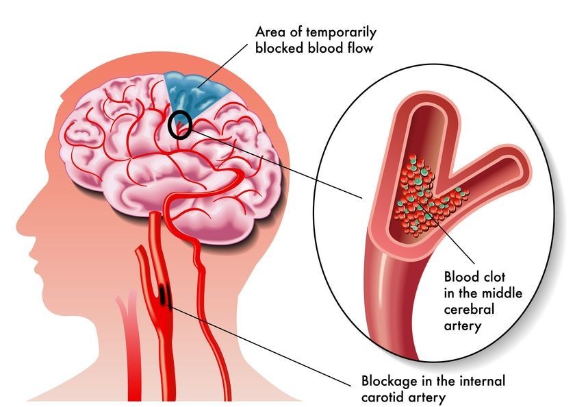 b2ap3_large_how-a-stroke-develops